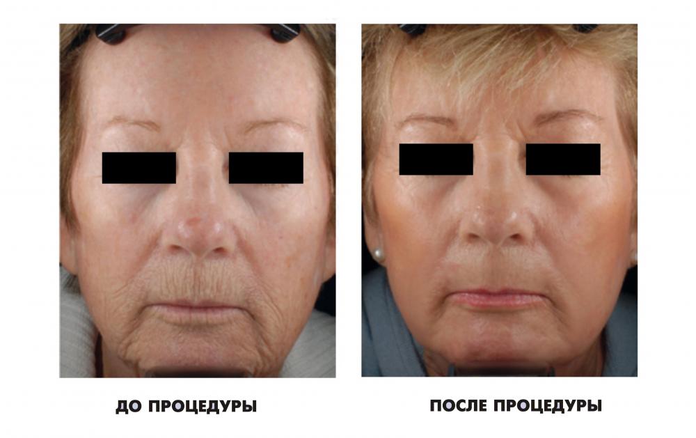 Радиоволновой лифтинг лица фото до и после